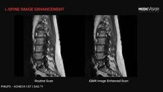 L-spine iQMR MRI image enhancement - Medic Vision Imaging Solutions.