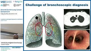 Lung Cancer Screening & Approach to Small Lesions Daniel Franzen: Introducing Navigation Broncho...