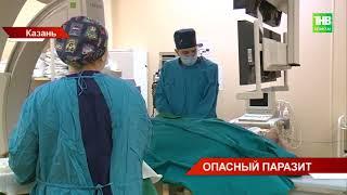 Уникальная операция: хирурги РКБ Казани из печени пациента удалили кокон-паразит