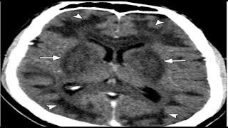 Differential Diagnosis for Bilateral Abnormalities of the Basal Ganglia and Thalamus#radiology#tips