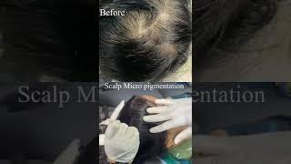 Scalp Micro Pigmentation For Hair Loss India | Scalp Micro Pigmentation