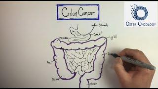 Colon Cancer: A Comprehensive Overview (Illustrative Tutorial by Oster Oncology)