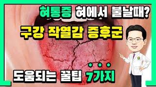 구강작열감증후군 해소하는 7가지 방법(혀의통증 설통 다스리기)