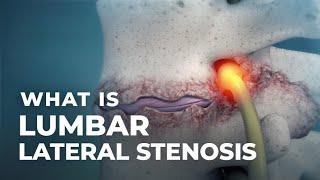 Lumbar Lateral Stenosis | @Atlantic Spine Center