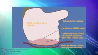 Central Florida Dental Implant Module 1 "Maxillary Antral-oral Fistula"