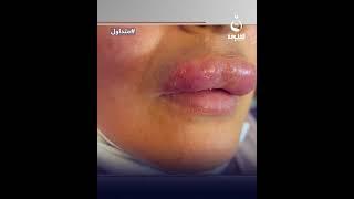حقنت "فيلر للشفة وتشوهت" شابة عراقية تقع بورطة #متداول
