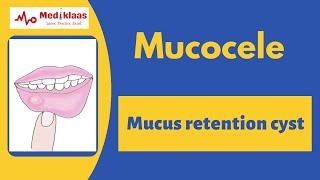 Mucocele l clincial features, Histopathology, treatment l Oral pathology l Mediklaas