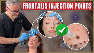 Injecting the Frontalis | Botox Injection Points & Safety Advice