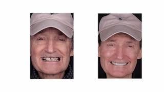 A New Smile Makeover at Any Age