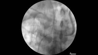 Palindrome Insertion Lt IJV with Slur-S Left Brachiocephalic Vein.(Fluoroscopic view)