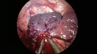 Management options to tackle bleeding during laparoscopy