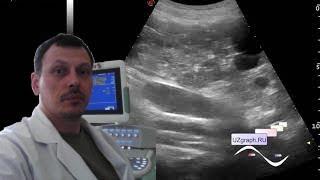 Kidney ultrasound - ADPKD