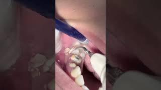 Scaling teeth #dentist #tartar