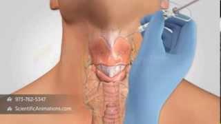 Vocal Cord Reconstruction