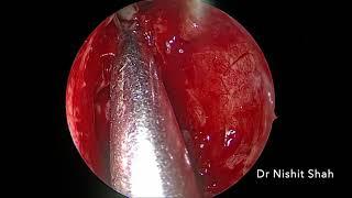 Patient information video on Endoscopic Sinus Surgery for sinusitis- Dr Nishit Shah