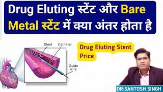 What are The Differences Between Drug Eluting Stent and Bare Metal Stent
