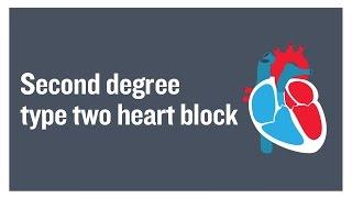 Second degree type two heart block