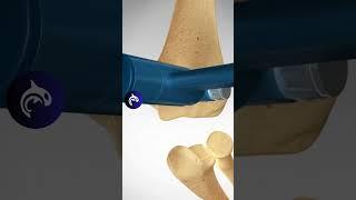 How does an Elbow Replacement work? 3D Animation