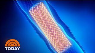 Stents, Bypass Surgery Called Into Question By New Study | TODAY