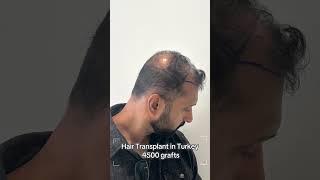 Hair Transplant in Turkey | Hair Transplant Process  #hairtransplantturkey