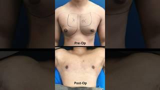 Assessing Gynecomastia Grade 2A | Immediate Result After 360° Surgery #ytshorts