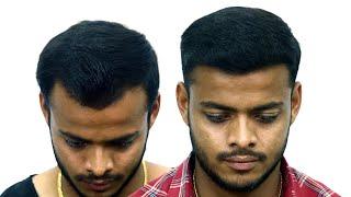 DHI Transplant: Best & Affordable in Kolkata | New Roots Hair Transplant Centre