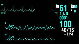 ECG monitor Экг монитор футаж Пульс сердца