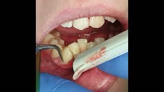 Удаление зубного камня в Доктор Профи