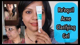 RE’EQUIL ACNE CLARIFYING GEL REVIEW | MOST EFFECTIVE FOR PIMPLES!!!