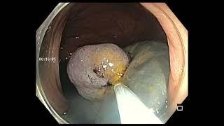 ASCENDING COLON POLYP - LARGE RESECTION - BETTER TO DO ENBLOC RESECTION