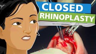 Closed Rhinoplasty