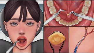 ASMR | Salivary Gland Stones Removal Animation