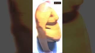 Gynecomastia surgery result | Cost of Gynecomastia surgery