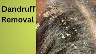 EXTREME DANDRUFF REMOVAL  | Huge Flakes