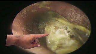 Ear wax cleaner