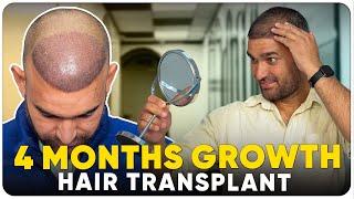 Hair Transplant in India | Best Results & Cost of Hair Transplant in India