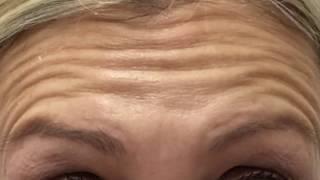 Botox forehead before and after