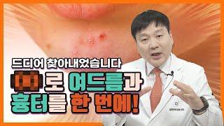 획기적인 여드름 치료법, 미국 피부과학회에서 발표합니다 | 피부지킴이 | #여드름 #여드름흉터 #골드PTT