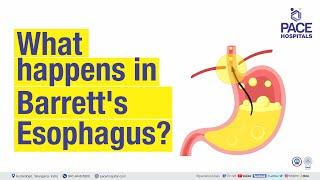 What happens in Barrett's Esophagus ? | PACE Hospitals #Shortvideo