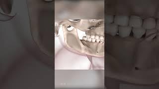 Corrective Jaw Surgery: Orthognathic Surgery