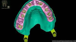 This Is How We Design Precise Implant Model