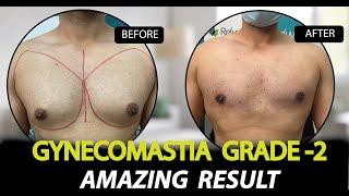 Gynecomastia Grade-2 Surgery with VASER Liposuction | Dr. Deepesh Goyal | Rejuvena Cosmo Care