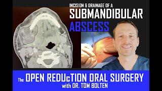 NECK ABSCESS DRAINAGE! HOW to DRAIN a SUBMANDIBULAR DENTAL INFECTION