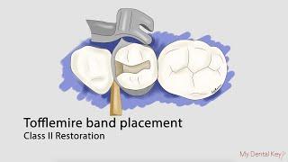 Tofflemire matrix band placement | My Dental Key