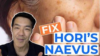 How to Treat Hori's Naevus | Dr Davin Lim