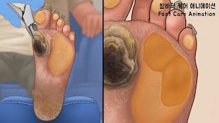 Treatment of severely hard and cracked feet (3D Animation) #shorts