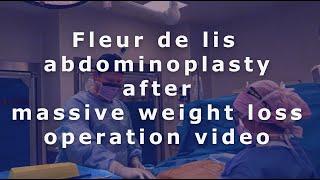 Transformative Operation Technique | Fleur de Lis Abdominoplasty with Dr. Bernard Beldholm