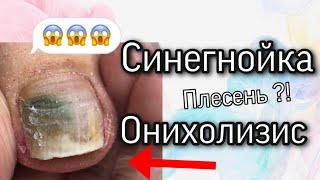 Под покрытием плесень ? Педикюр / онихолизис / отслоение ногтя / синегнойка на ногте /что мы сделали