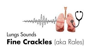 Fine Crackles (Rales) - Lung Sounds - MEDZCOOL