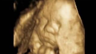 3D Scan, 3D Ultrasound ~ Dublin Ireland